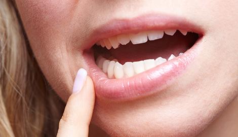 gingivitis
