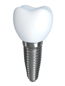 Tooth implant